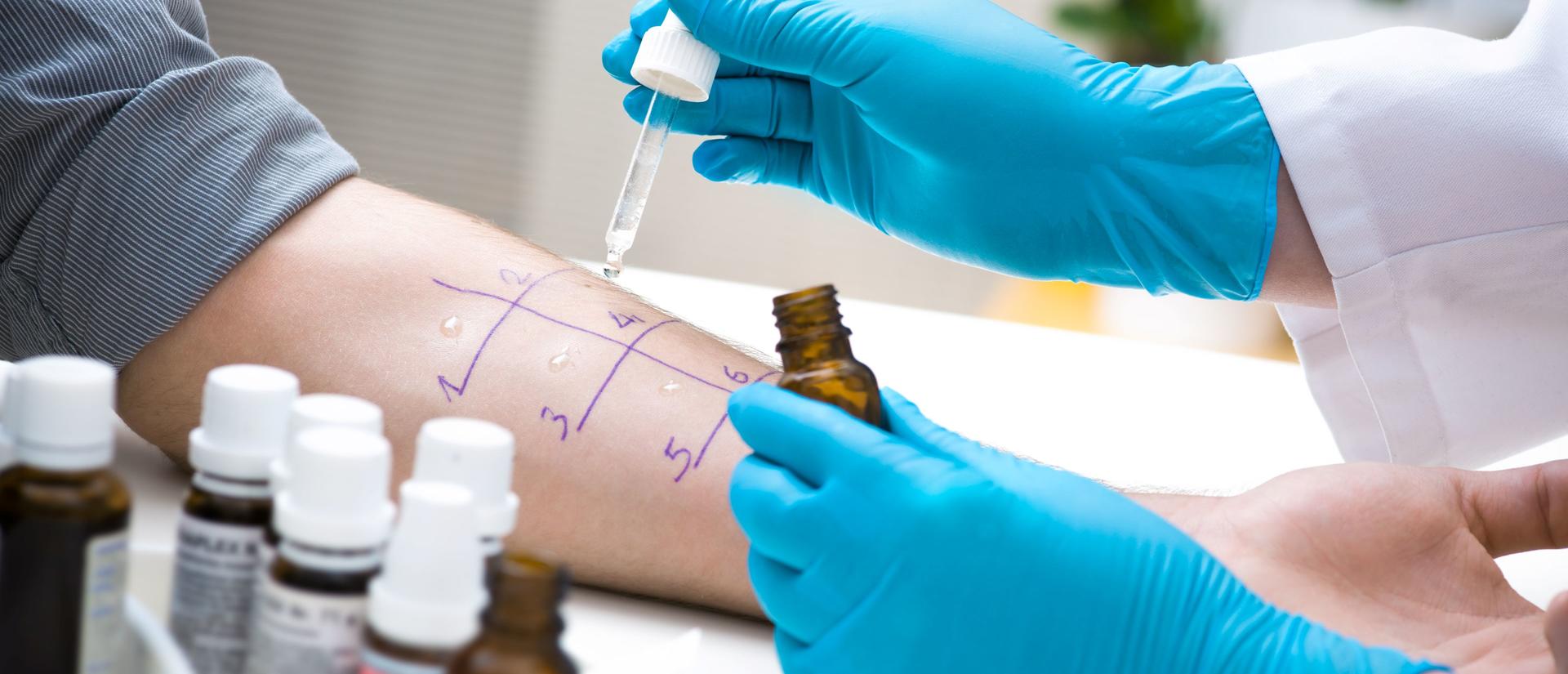 Allergist performing a skin prick allergy test on a patient